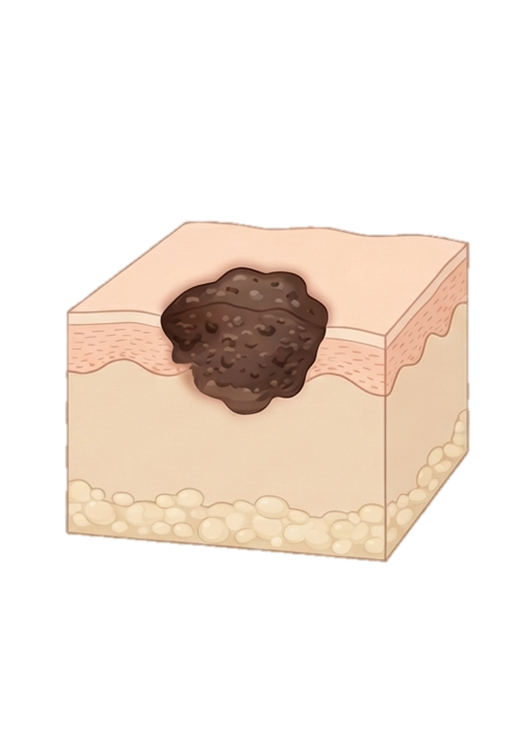 Melanoma