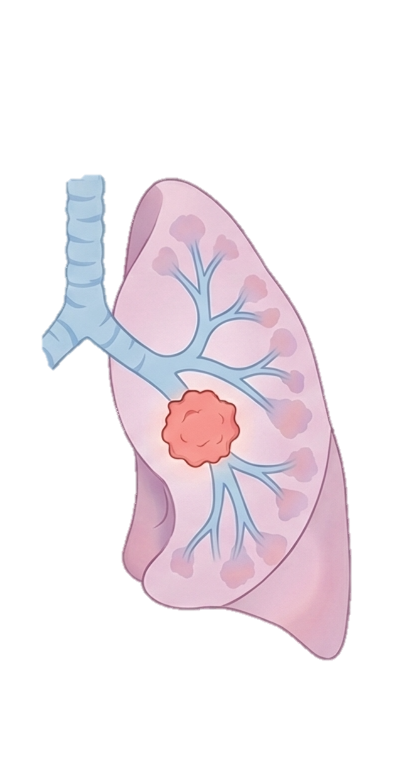 NSCLC